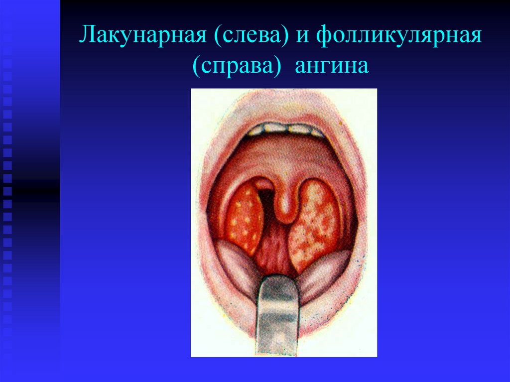 Лакунарная (слева) и фолликулярная (справа) ангина