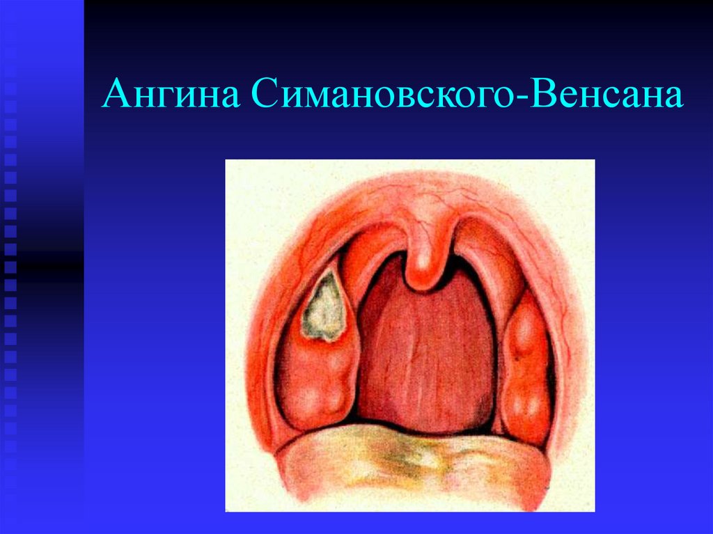 Ангина Симановского-Венсана