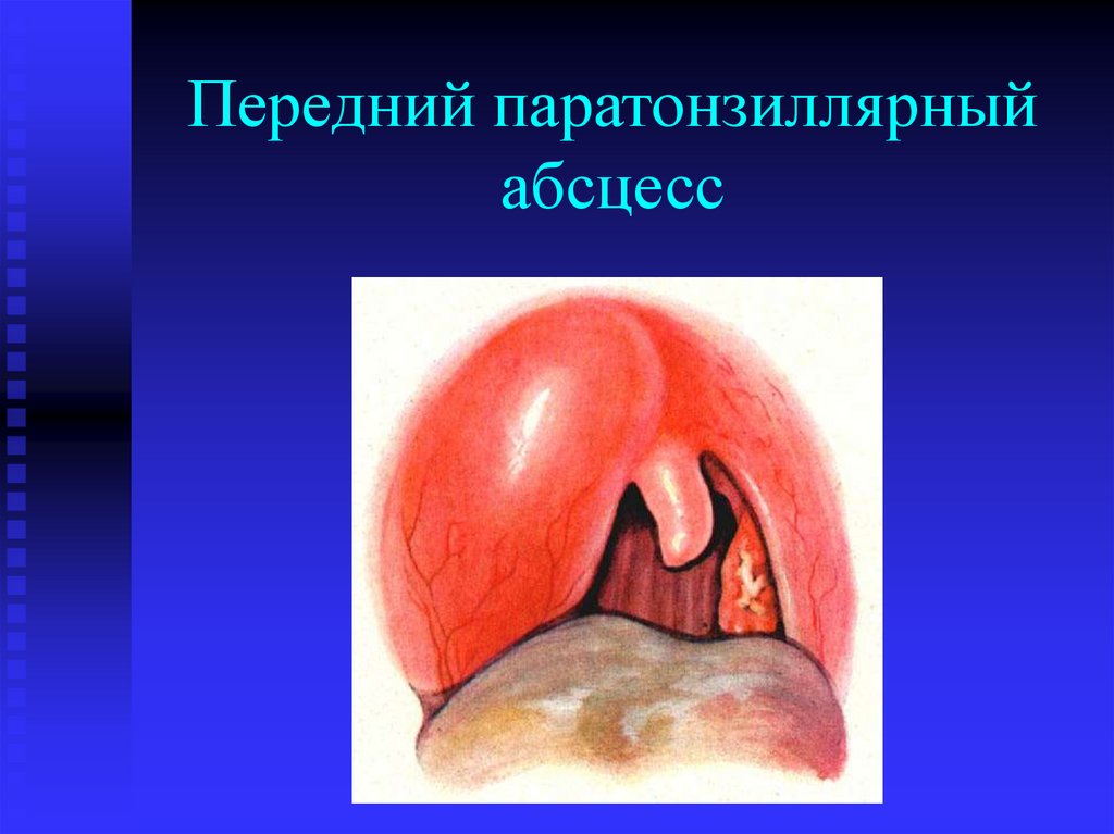 Передний паратонзиллярный абсцесс