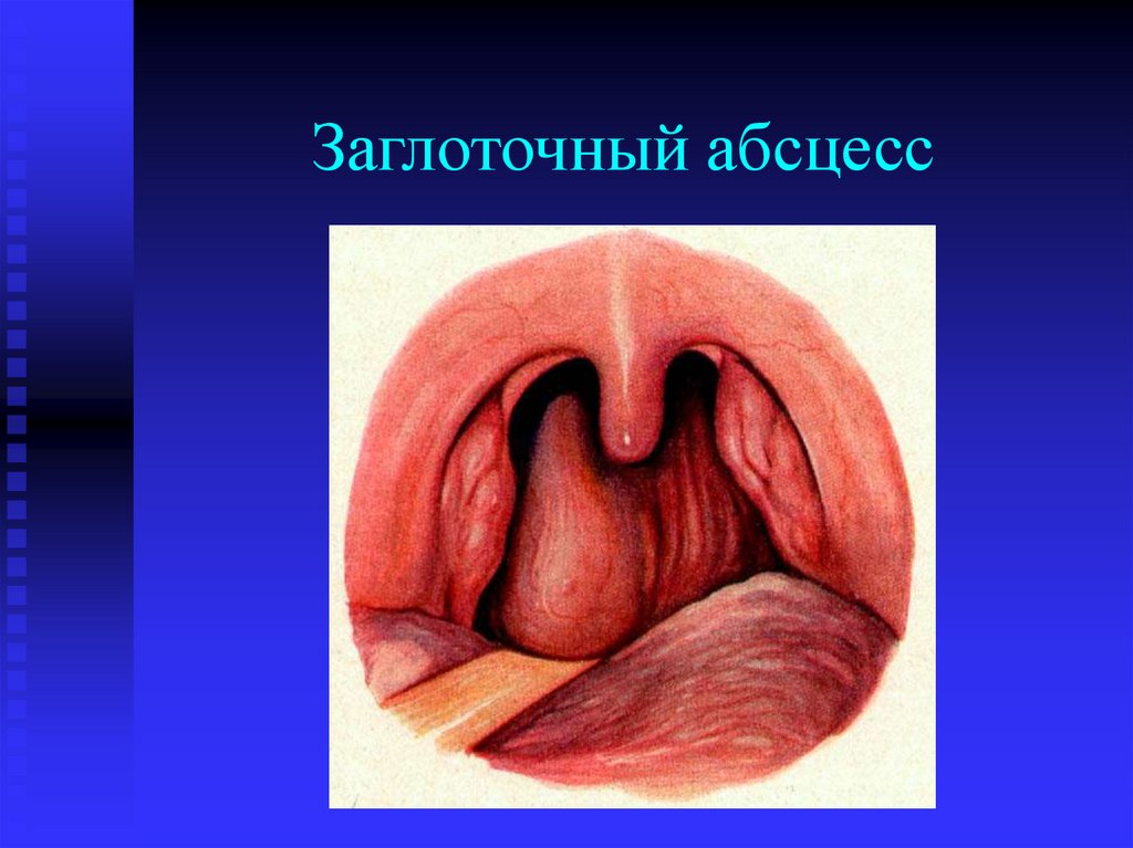 Заглоточный абсцесс