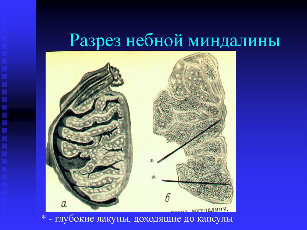 Разрез небной миндалины