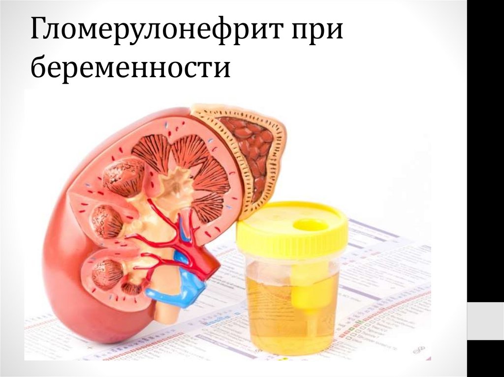 Гломерулонефрит при беременности