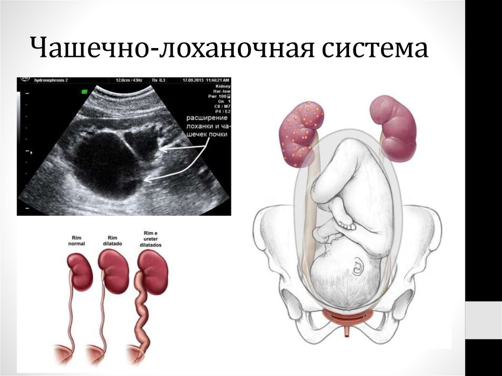 Чашечно-лоханочная система