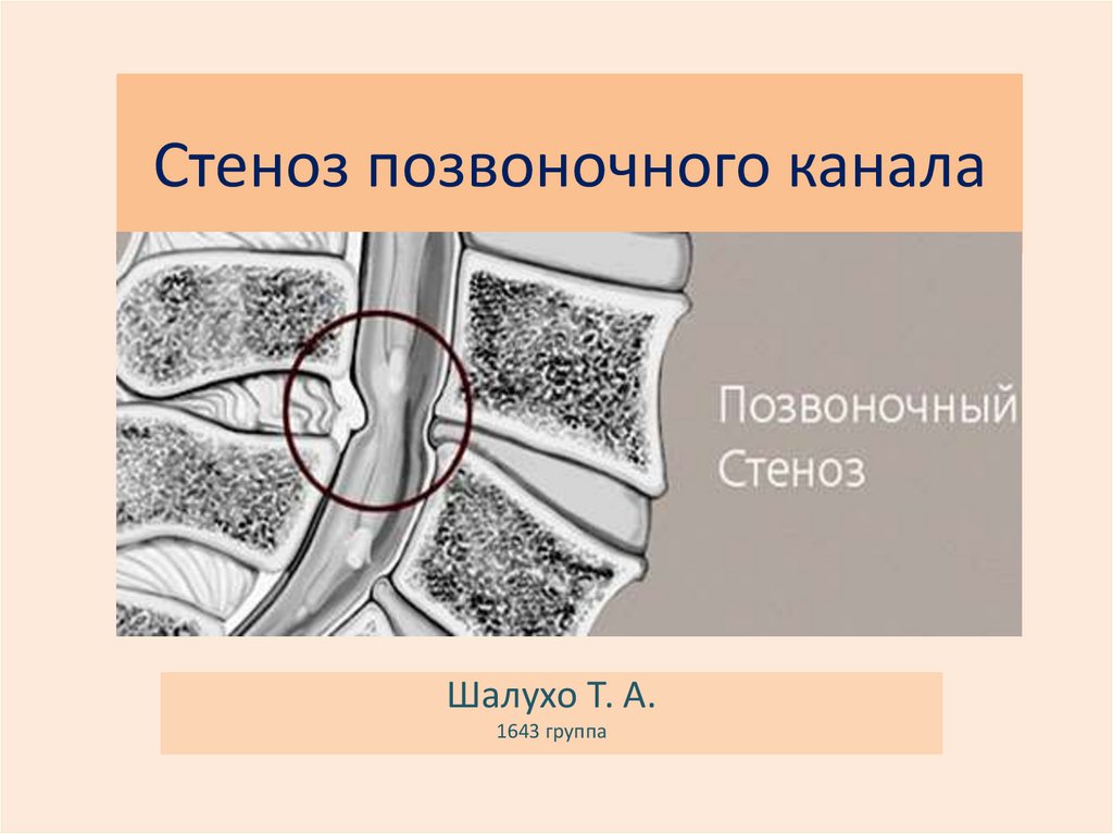 Стеноз позвоночного. Сагиттальный стеноз позвоночного канала с5-с7. Относительный стеноз спинномозгового канала. Степени стеноза позвоночного канала. Норма позвоночного канала.