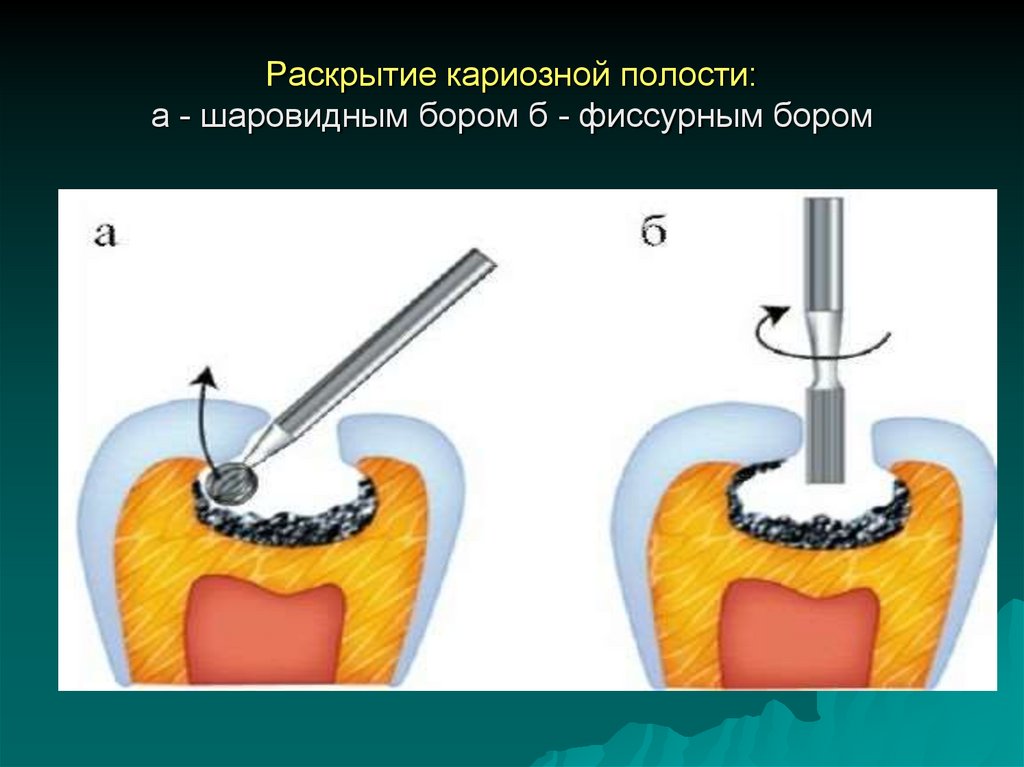 Пломбирование полости. Принципы препарирования кариозных полостей. Формирование дна кариозной полости 5 класса проводят бором. Фиссурный Бор для формирования кариозной полости. Инструменты для зондирования кариозных полостей II класса..