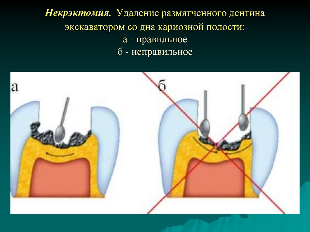 Полость провожать. Некрэктомия кариозной полости. Некрэктомия 5 класса по Блэку. Размягченный дентин кариозной полости. Этапы пломбирования кариозных полостей.