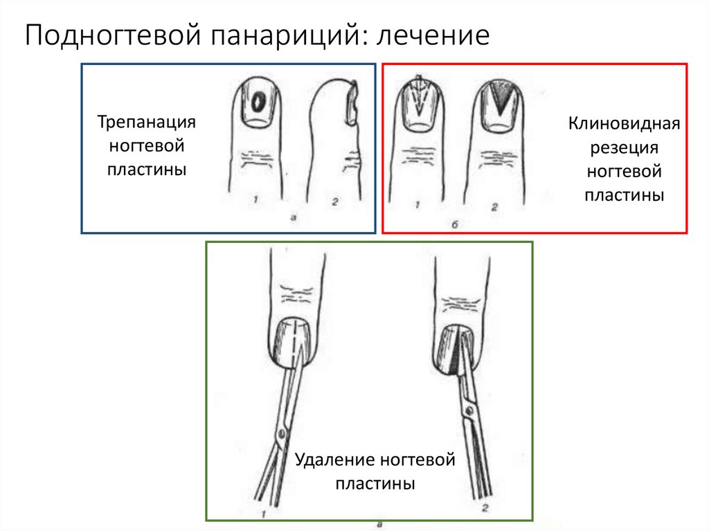 Виды панариция