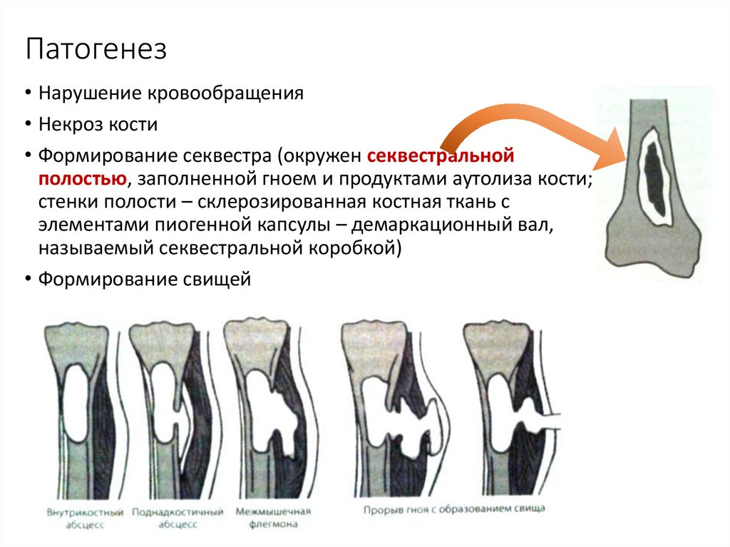 Презентация гнойные заболевания костей и суставов