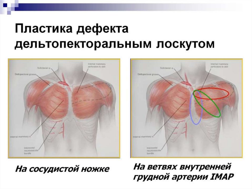 Пластика дефекта дельтопекторальным лоскутом