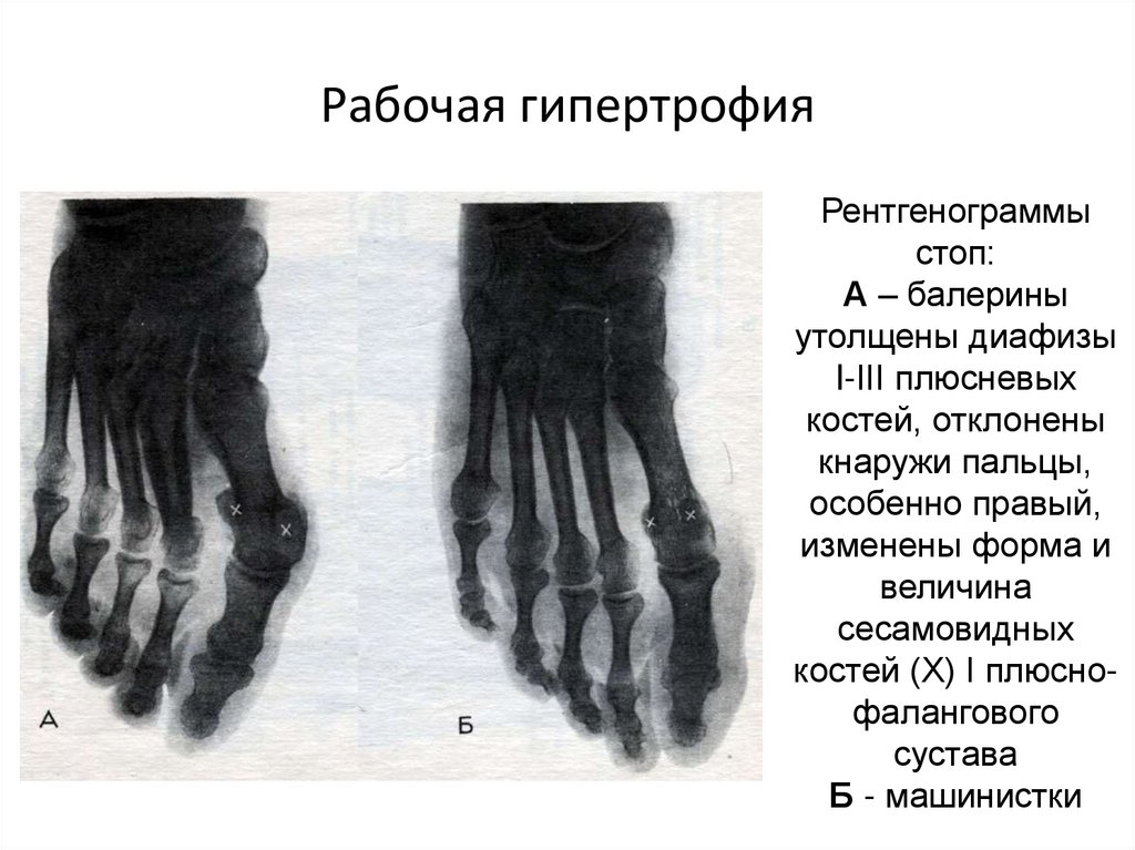 Плюсневая кость руки. Аномалии развития плюсневых костей. Плюсно фаланговые суставы. Гипоплазия плюсневой кости. Сесамовидные кости кисти рентген.