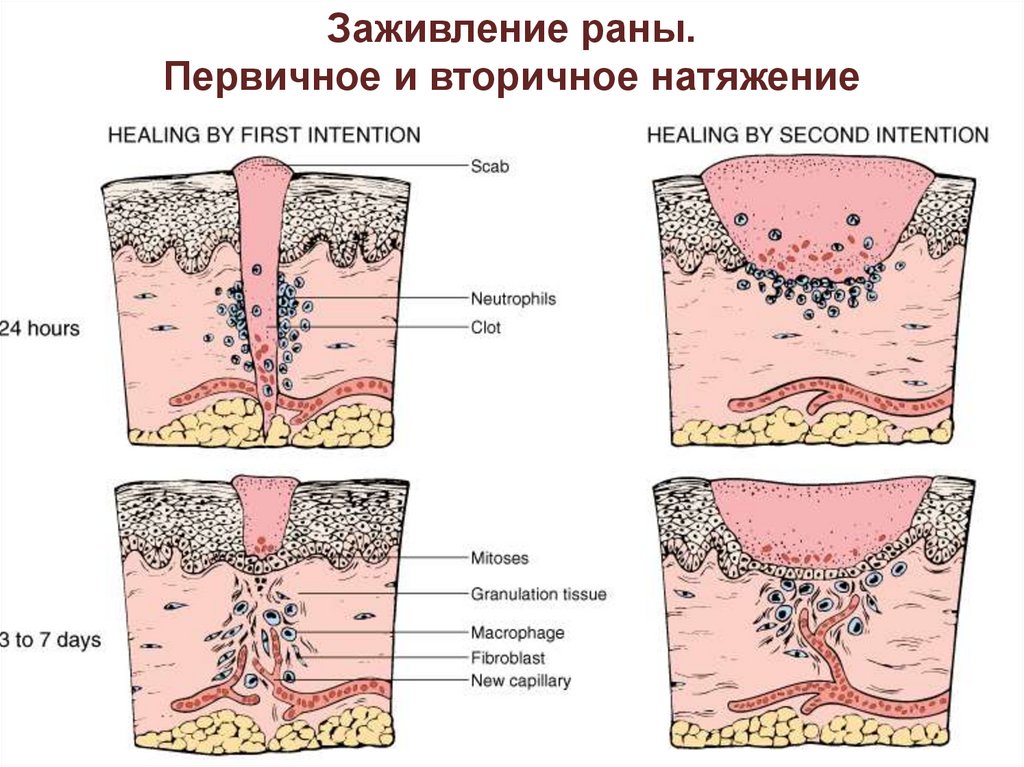 Вторичная рана. Заживление РАН первичным и вторичным натяжением. Заживление раны вторичным натяжением. Первичное и вторичное натяжение раны. Вид рубца при заживлении раны первичным натяжением.