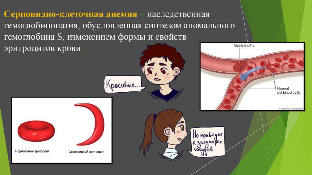 Ген серповидноклеточной анемии. Серповидноклеточная анемия. Серповидно-клеточная анемия человека. Серповидноклеточная анемия (гемоглобинопатия).