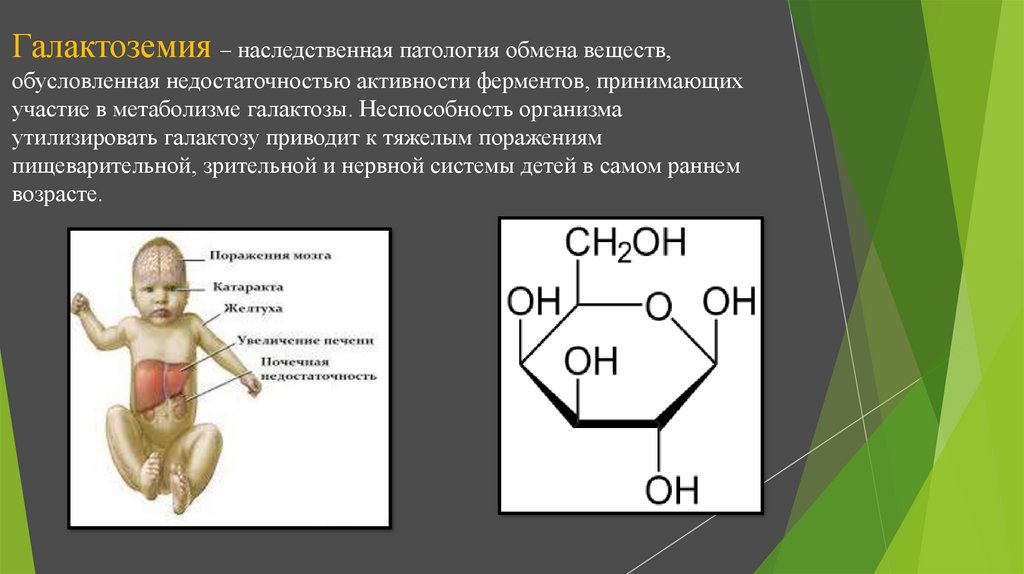 Галактоземия презентация по генетике