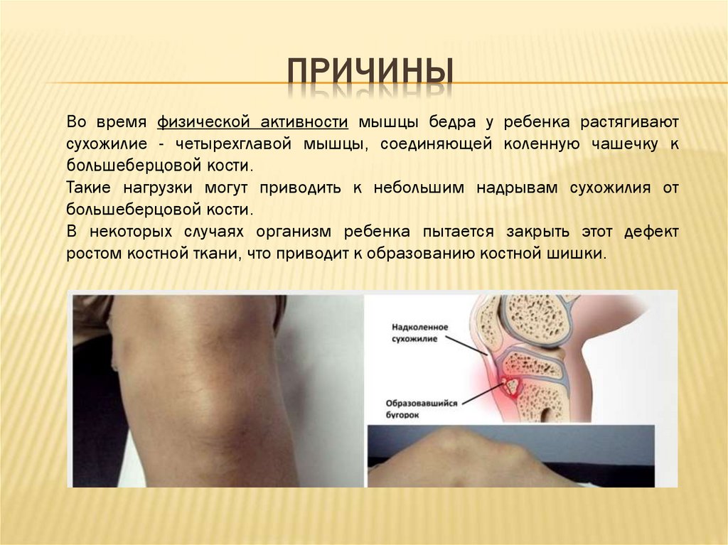 Болезнь Осгуда - Шляттера - online presentation