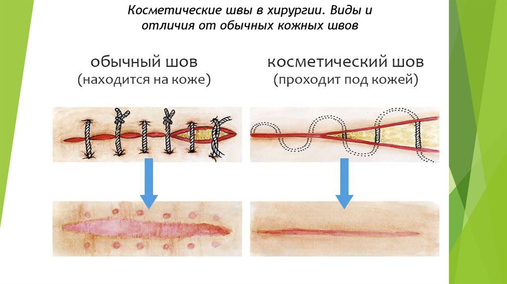 Разошелся косметический шов фото