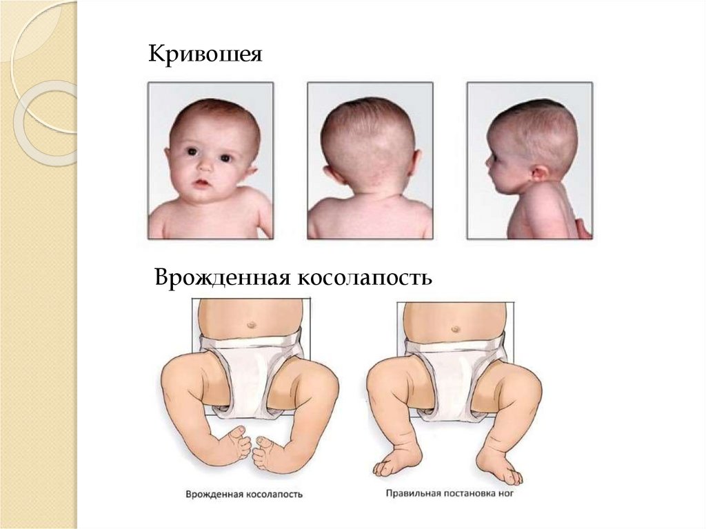 Кривошея это. Врождённая кривошея новорожденного. Симптомы кривошеи у грудничков 5 месяцев.