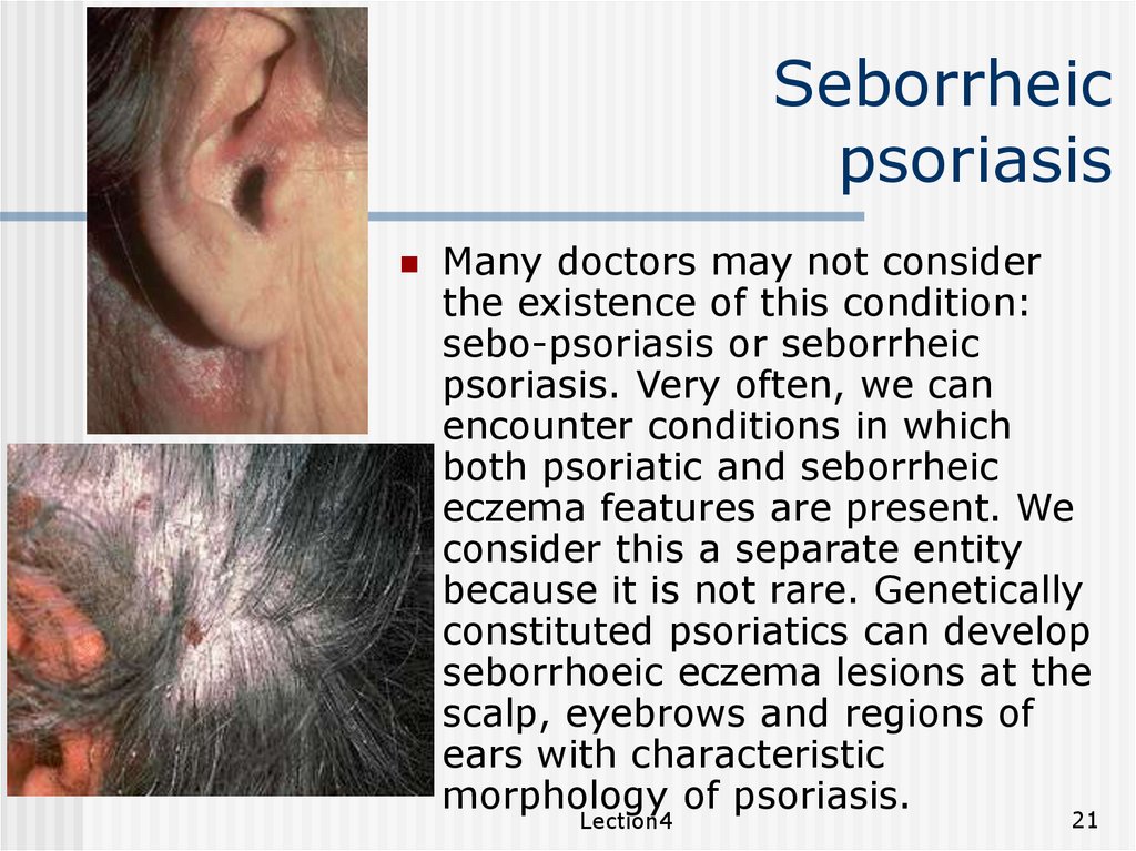 Viszketés a füle a psoriasis