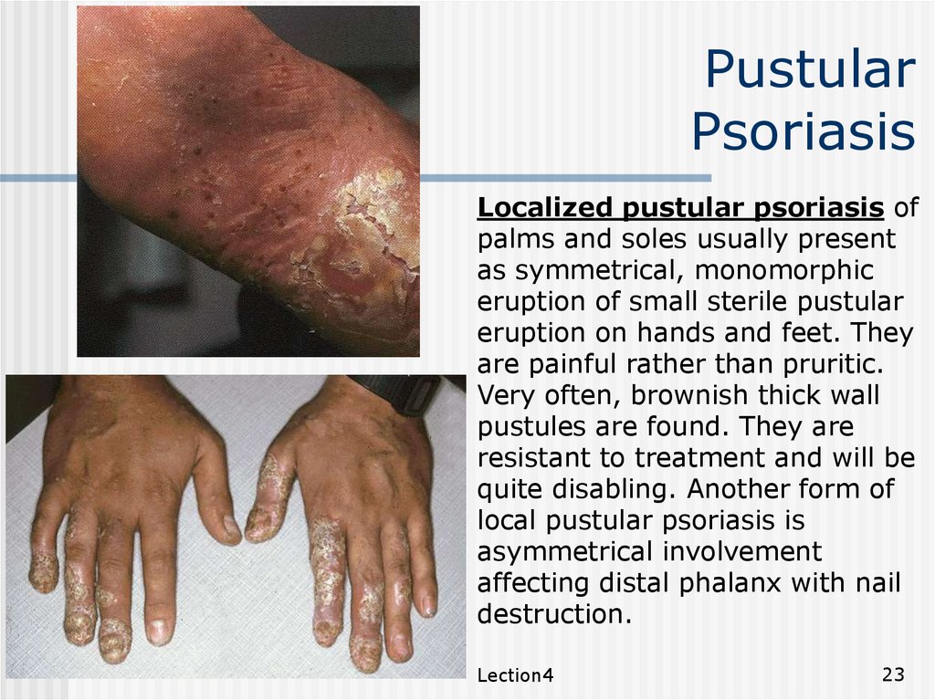 extensive psoriasis treatment
