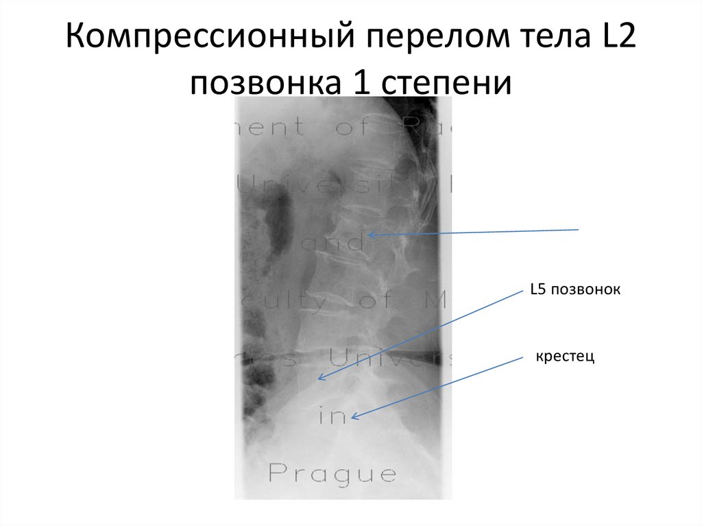 Компрессионный перелом l2 позвонка. Консолидированный компрессионный перелом тела позвонка l1. Компрессионный перелом позвоночника л2. Компрессионный перелом л2 позвонка. Компрессионный перелом тела 1 1