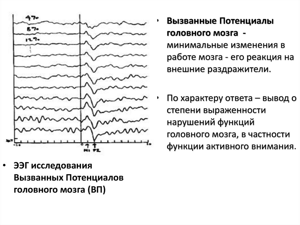 Потенциал ээг. Метод вызванных потенциалов это ЭЭГ?. Метод вызванных потенциалов головного мозга. Регистрация зрительно вызванных потенциалов коры головного мозга. Вызванные потенциалы (ВП).