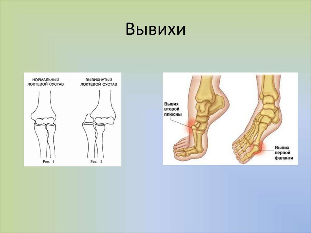 Растяжение связок презентация