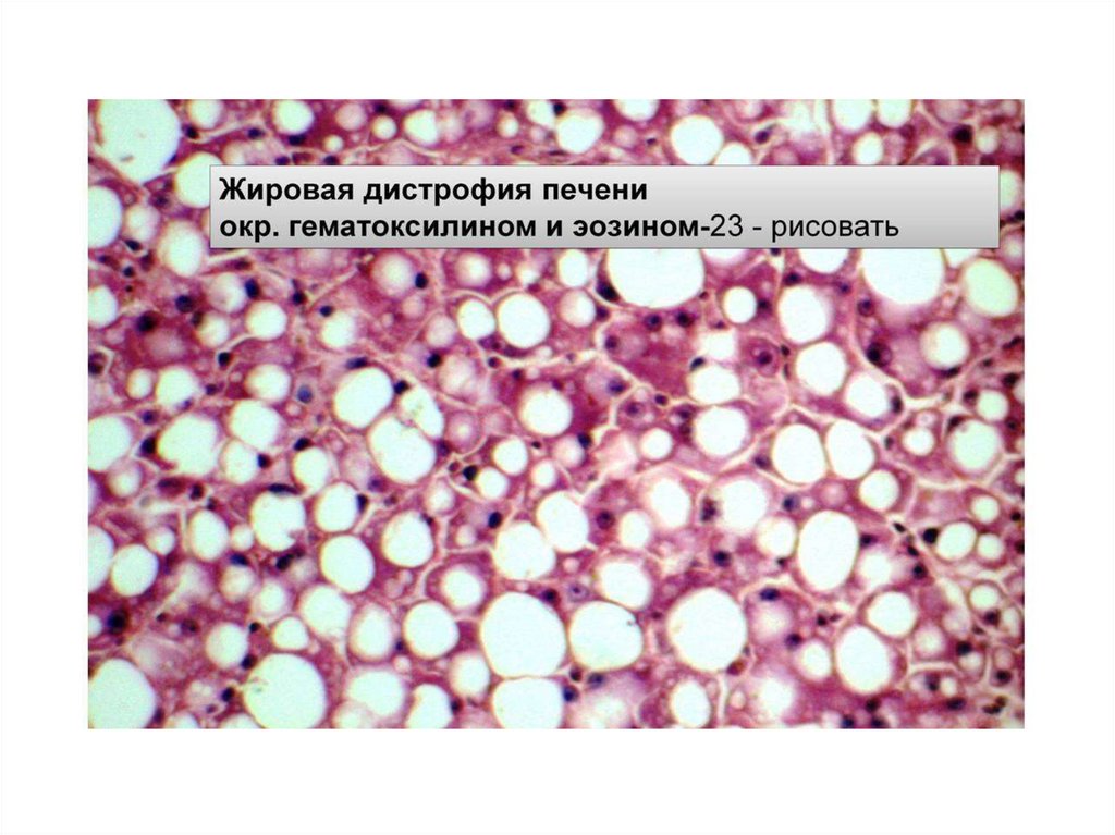 Дистрофия это. Жировая дистрофия печени патанатомия. Дистрофия патанатомия. Этиология жировой дистрофии.