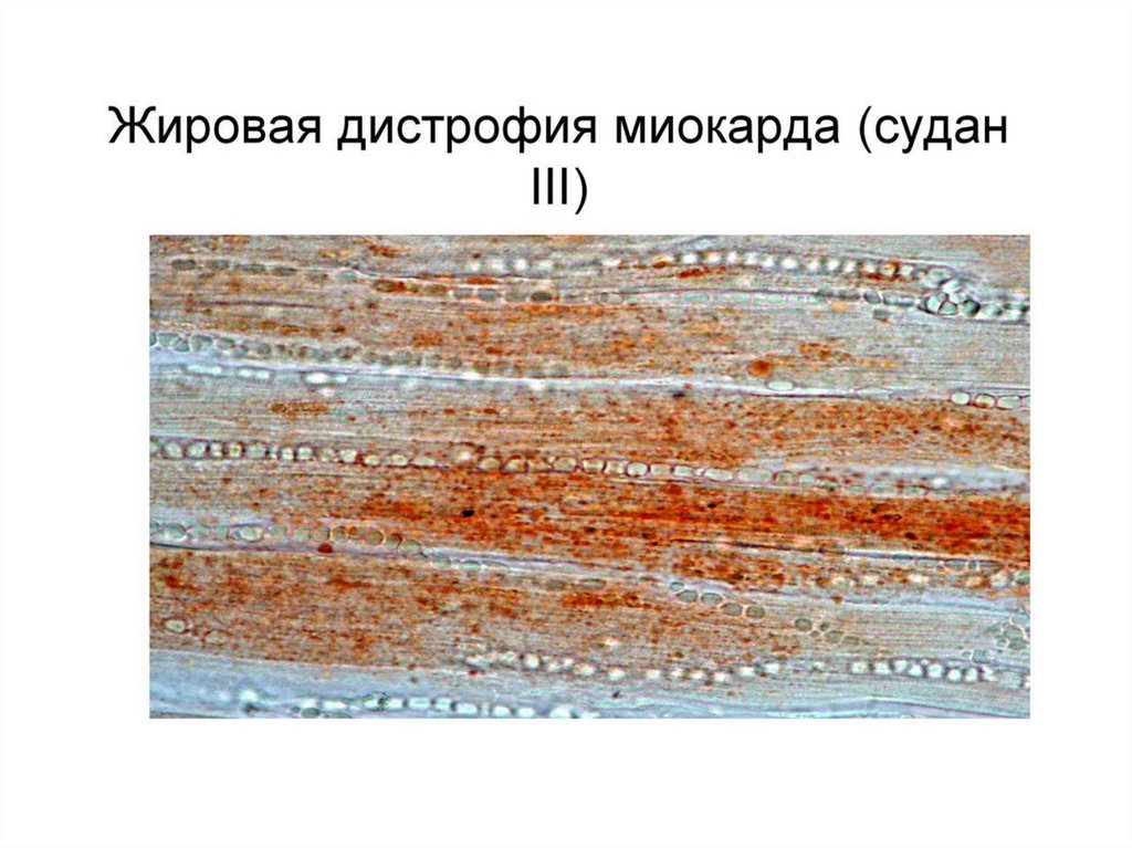 Жировая дистрофия презентация