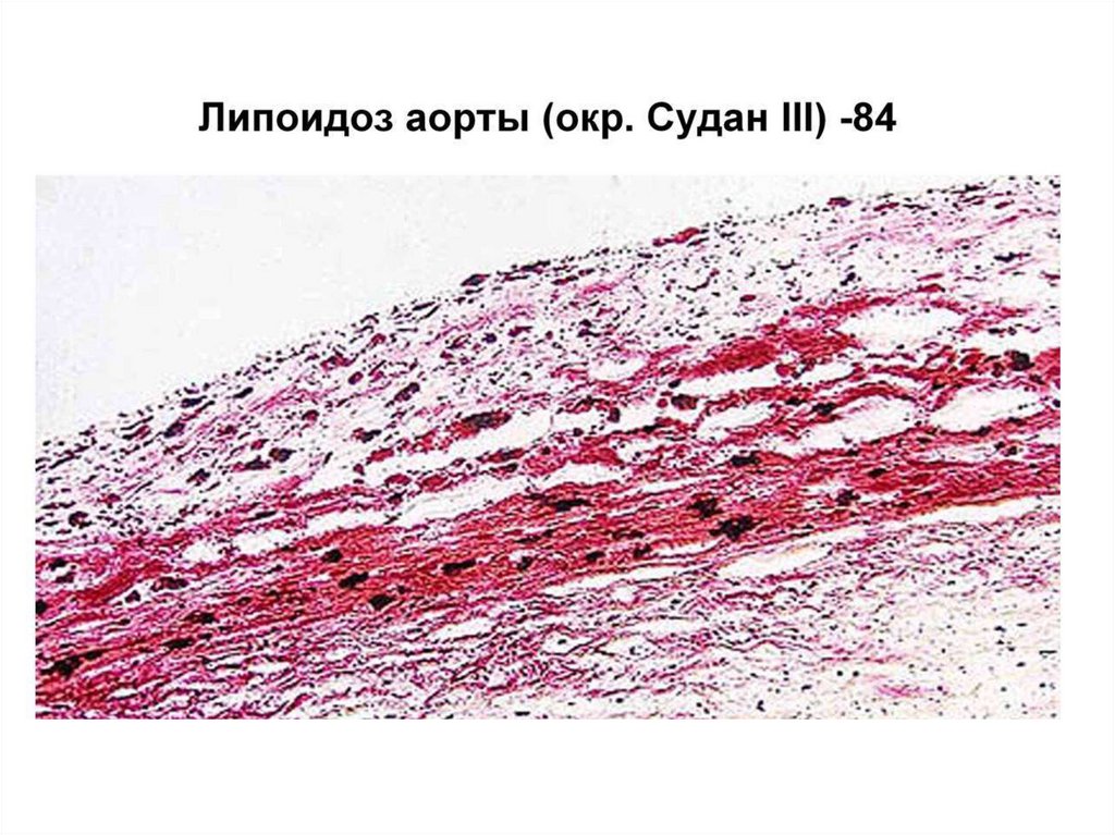 Жировая дистрофия миокарда. Стромально-сосудистые жировые дистрофии (липидозы). Стромально-сосудистые дистрофии микропрепарат. Жировая дистрофия патанатомия. Миокардиологическая дистрофия.