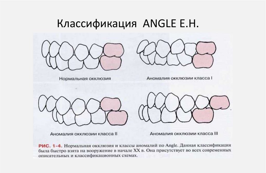 Виды прикуса схема