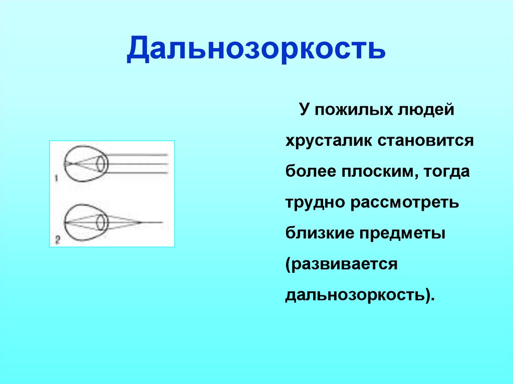 Дальнозоркость презентация физика