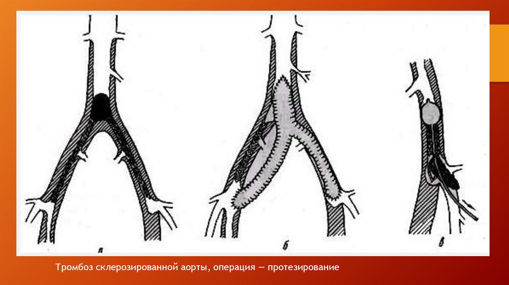 Аорты нижних конечностей. Окклюзия бифуркации аорты. Тромбоз бифуркации аорты. Окклюзия магистральных артерий нижних конечностей. Эмболия магистральных артерий.