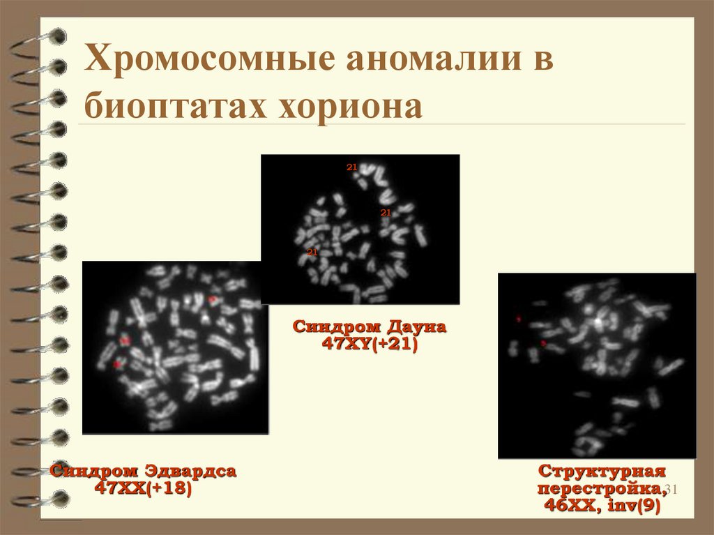 Риск хромосомных аномалий