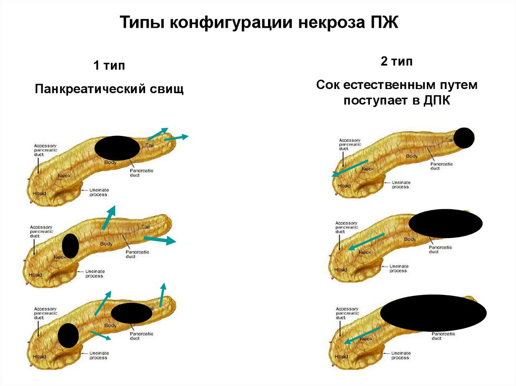 Морфологические виды некроза