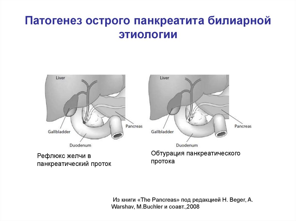 Билиарный панкреатит