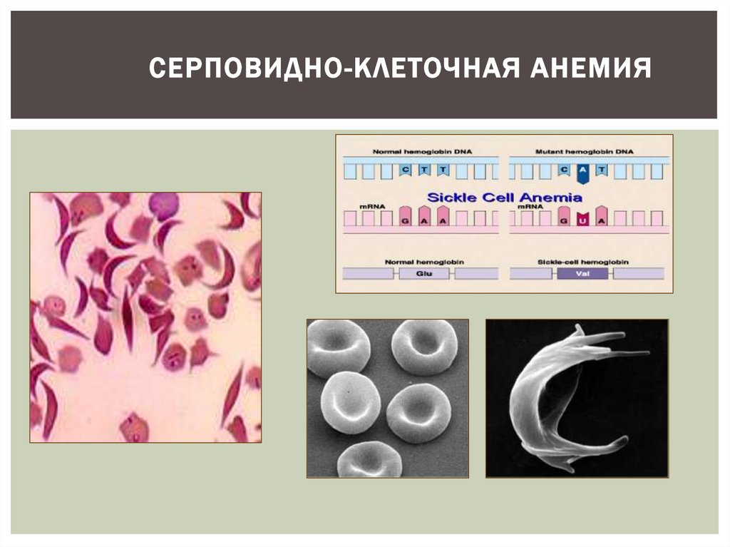 Анемия биохимия. Серповидно клеточная анемия. Серповидноклеточная анемия патофизиология. Серповидноклеточная анемия мазок. Серповидноклеточная анемия презентация.