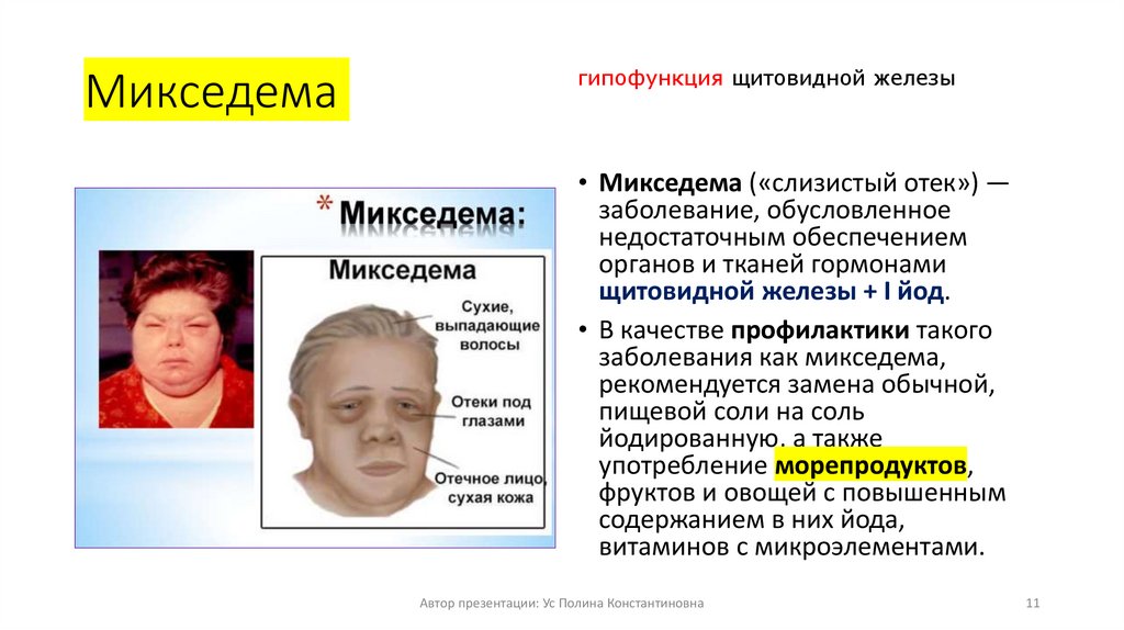 Микседема