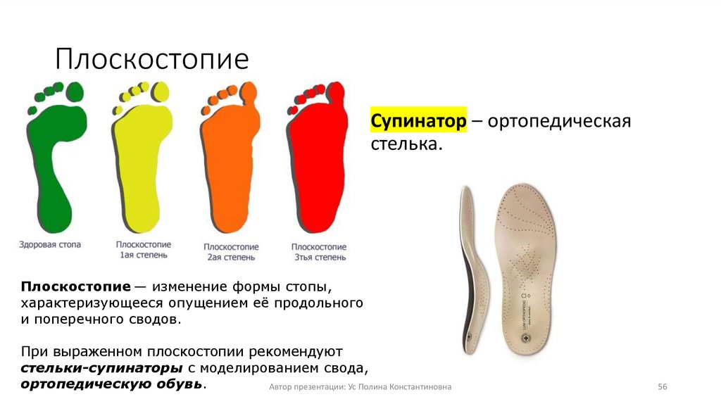 Плоскостопие