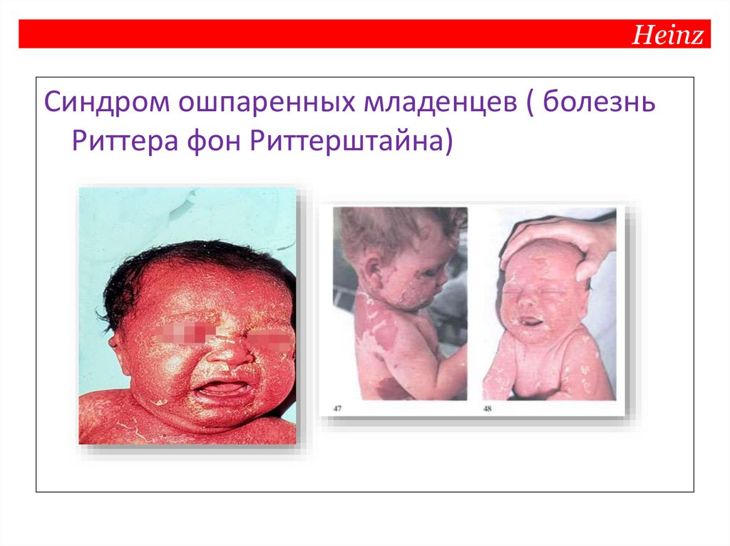 Стафилококк. Staphylococcus aureus как условнопатогенный микроорганизм ...