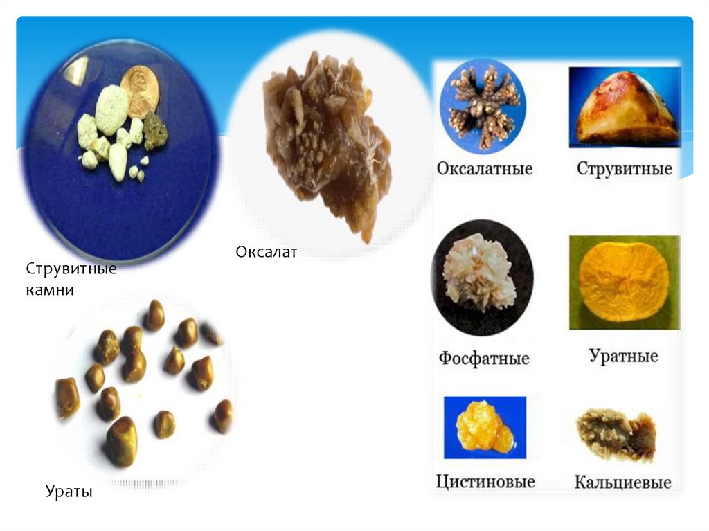 Анализ камня из почки москва