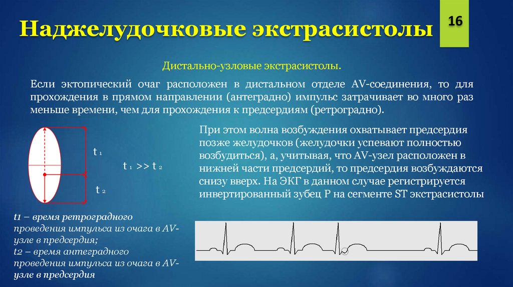 Экстрасистолы в сутки