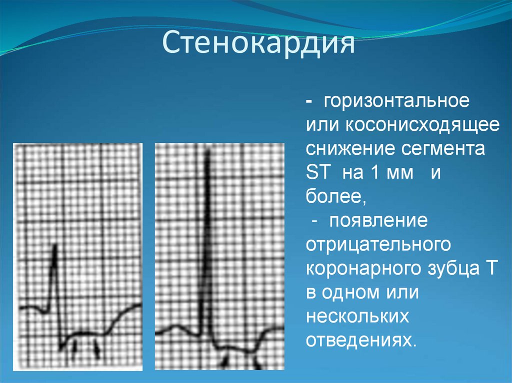 Сегмент st на экг