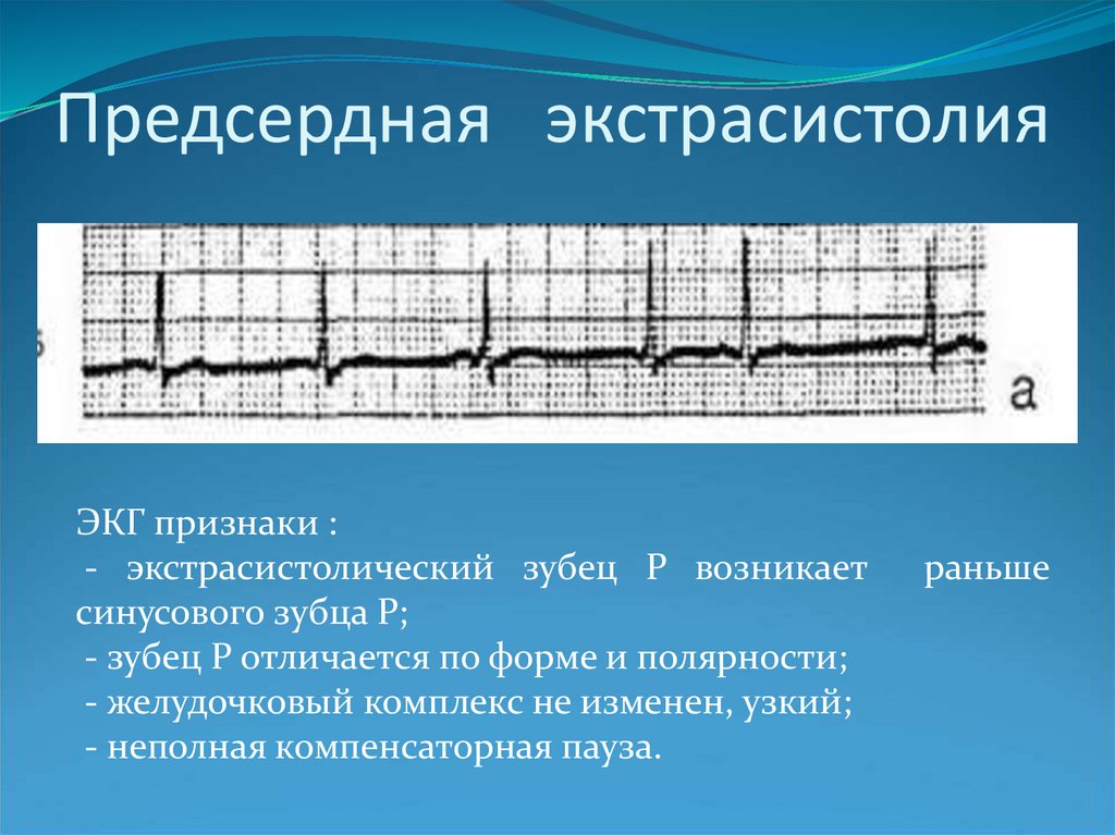 Экстрасистолия на экг. Предсердная экстрасистолия на ЭКГ. Предсердная экстрасистолия на ЭКГ признаки. ЭКГ критерии предсердной экстрасистолии. Блокированная предсердная экстрасистолия на ЭКГ.