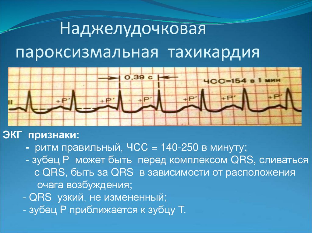 Экг картина при пароксизме суправентрикулярной тахикардии имеет вид