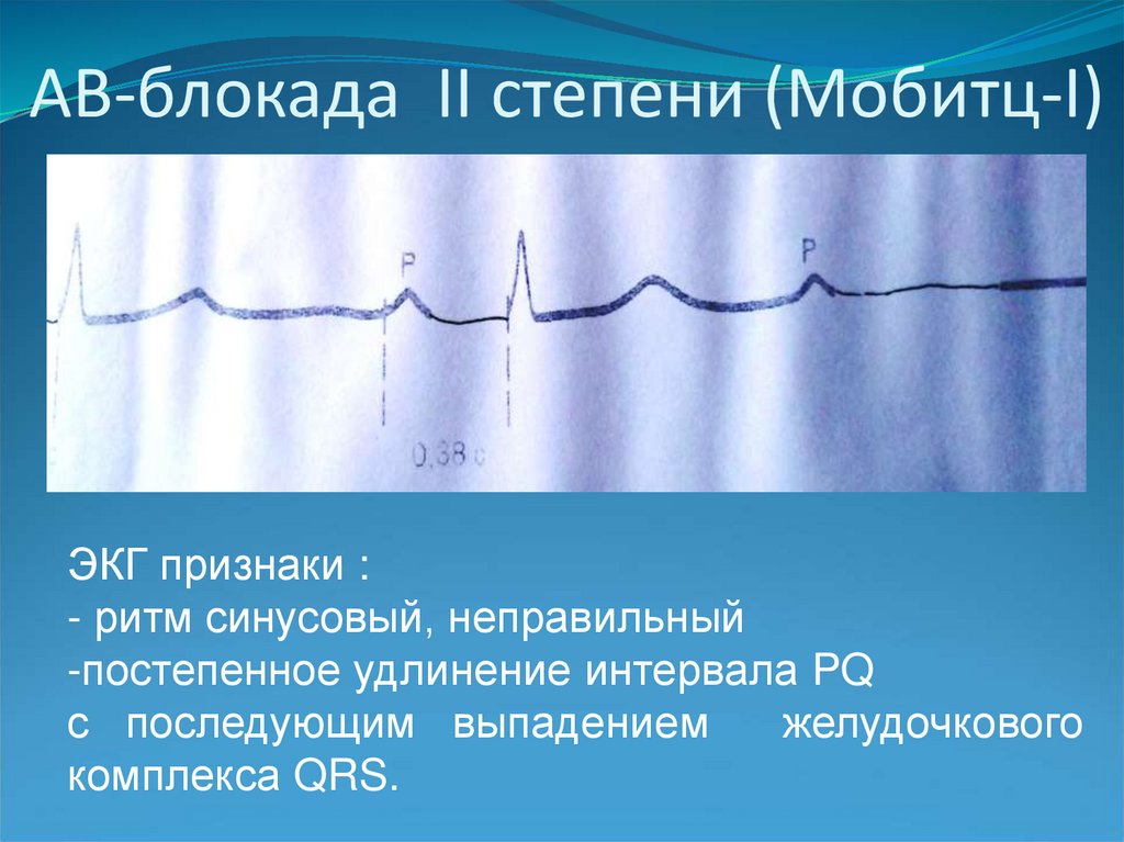 Мобитц 1 и 2. Мобитц 1 и 2 на ЭКГ отличия. Экстрасистолия Мобитц.