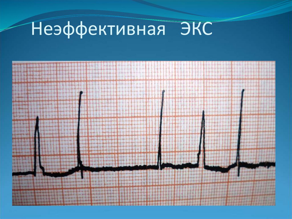 Путем экс. ЭКГ при экс. Гиперсенсинг экс на ЭКГ. Псевдосливные комплексы на ЭКГ при экс. Сливные комплексы на ЭКГ при экс.