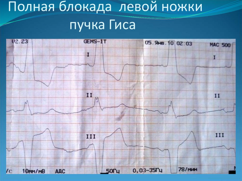 Лечение полная блокада левой ножки