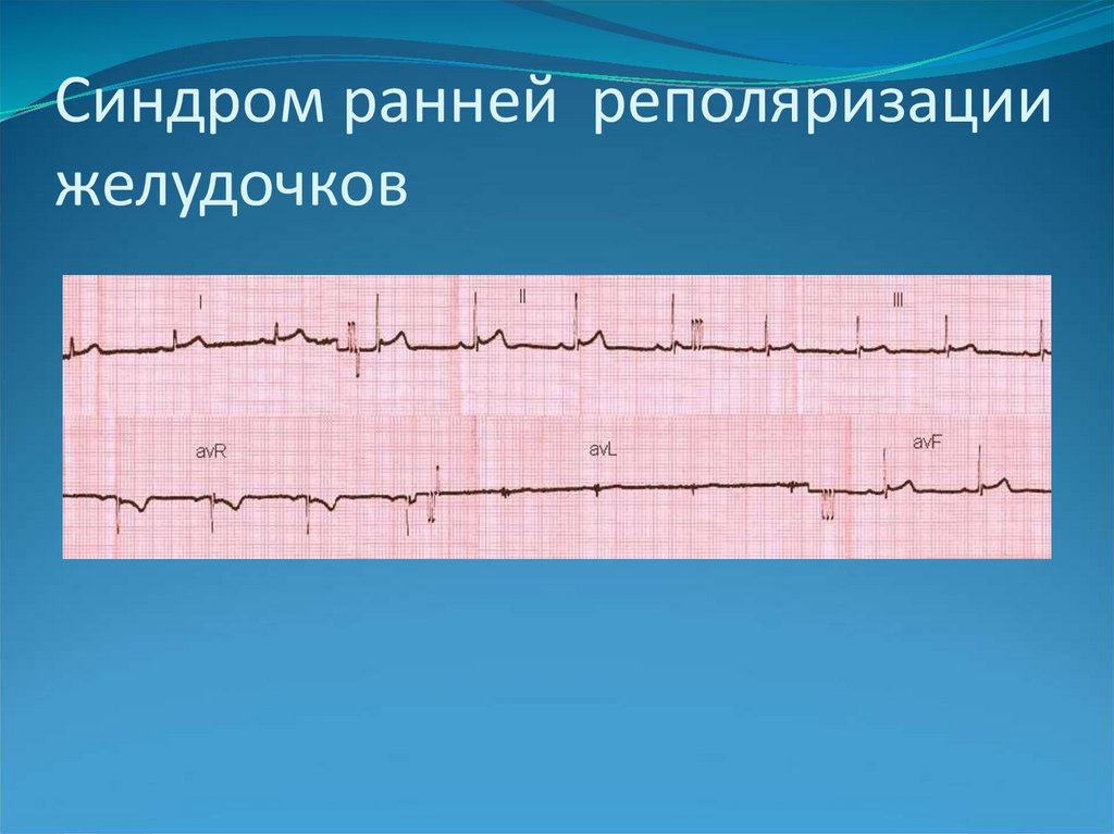 Ранний желудочков. Ранняя реполяризация желудочков на ЭКГ. Ранняя реполяризация желудочков сердца на ЭКГ. Феномен РРЖ на ЭКГ. Синдром ранняя реполяризация желудочков.