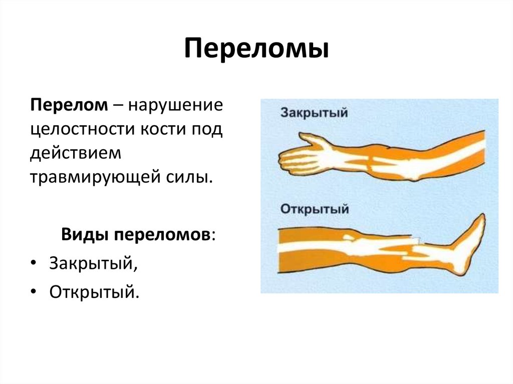 Какой вид травмы скелета изображен на рисунке растяжение связок перелом кости трещина кости вывих