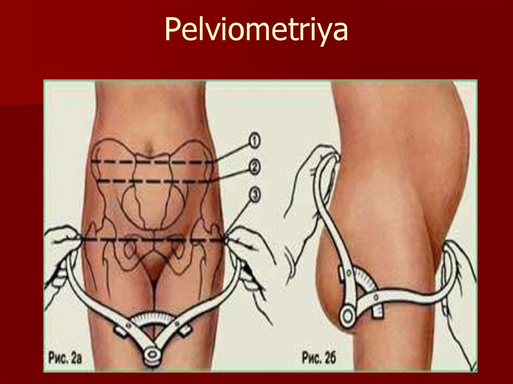 Исследование таза. Наружная пельвиометрия алгоритм. Измерение таза беременной пельвиометрия. Измерение размеров таза пельвиометрия. Наружная пельвиометрия в акушерстве.