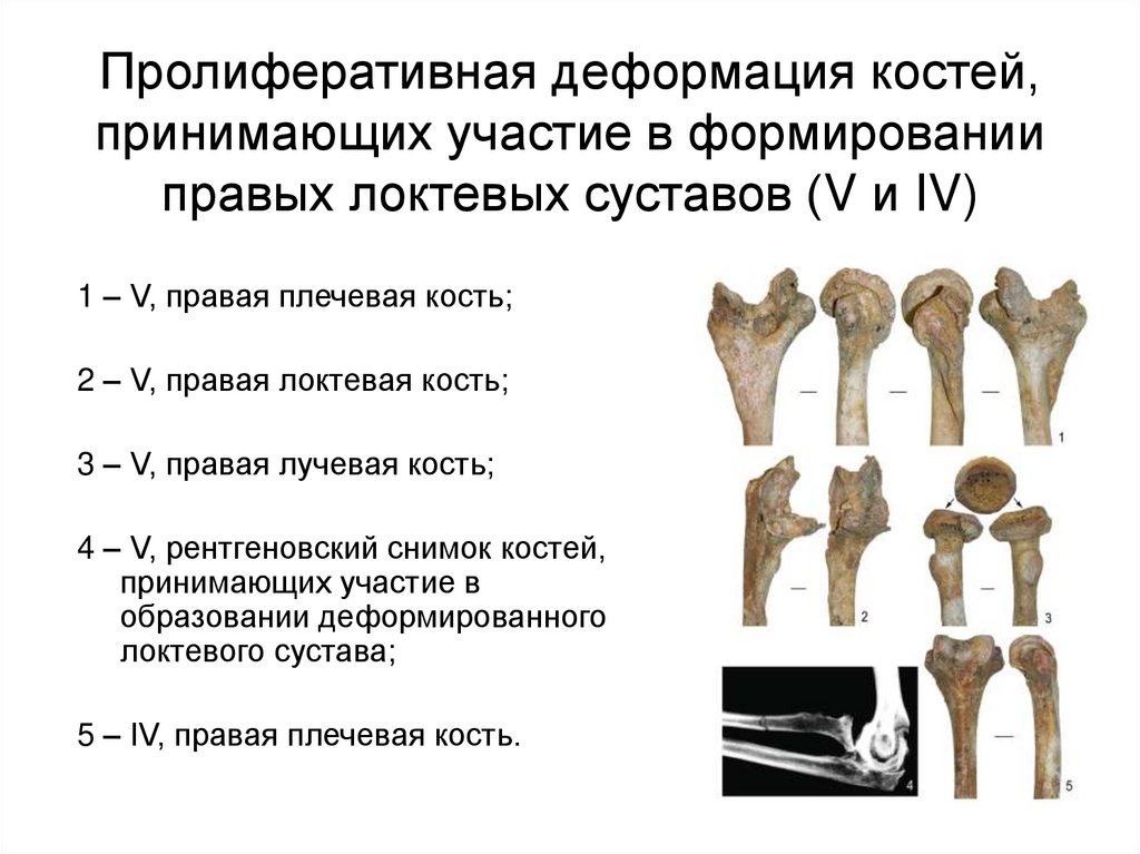 Лечение деформаций костей. Виды деформации костей. Какие кости участвуют в образовании твердого (костного) неба?. Виды деформации костей судебная медицина.